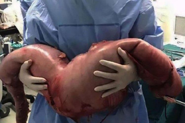 Inilah usus besar Zhou Hai yang bermasalah dan harus dipotong tim dokter RS Rakyat Ke-10, Shanghai, China, pekan lalu.(Shanghaiist)